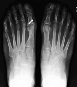 Röntgenbild der Füße.